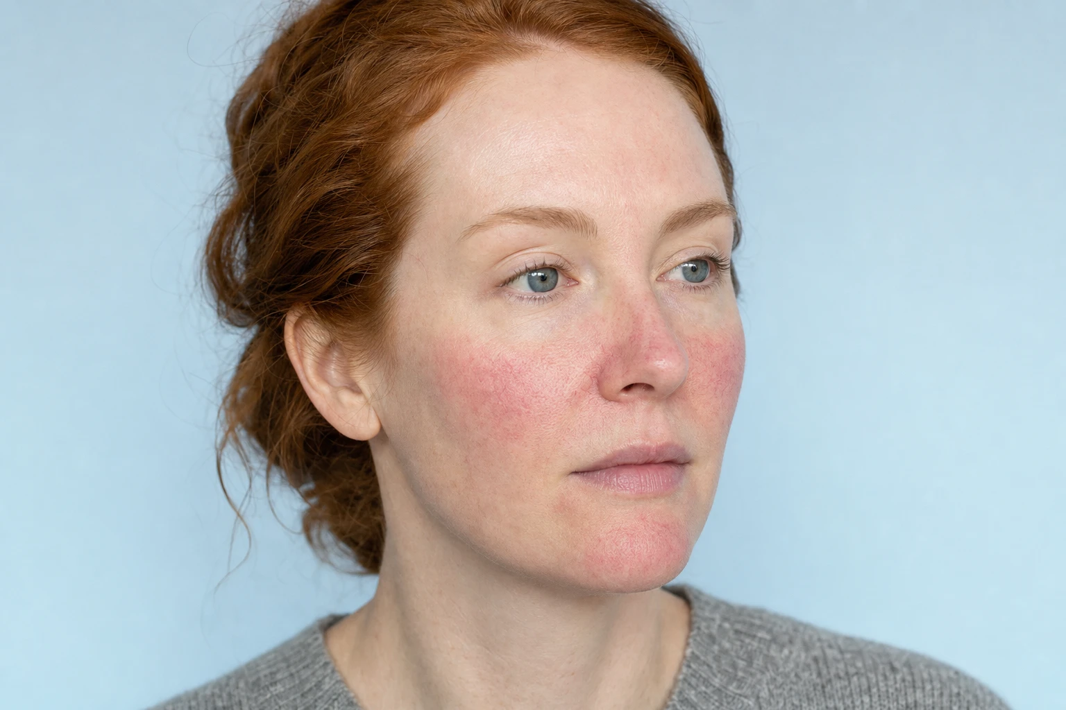 Three-quarter portrait of an auburn-haired woman with visible redness on her cheeks, nose and chin.