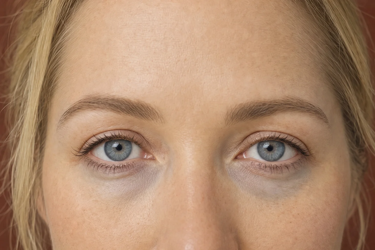 Illustration: frontal close-up of the eyes of a fictional woman with blonde hair and blue eyes, with a slight blue-grey tint under the eyes, as seen with the Tyndall effect.
