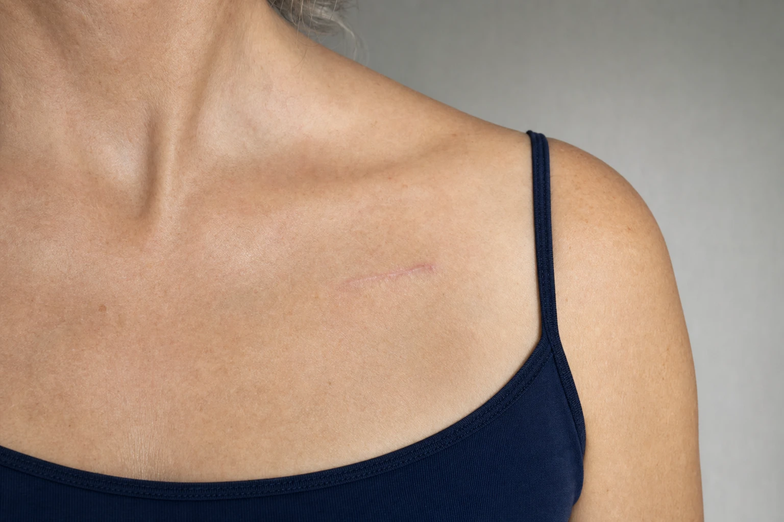 Fictional illustration of a slightly raised, pinkish linear scar near the collarbone, on fair skin.