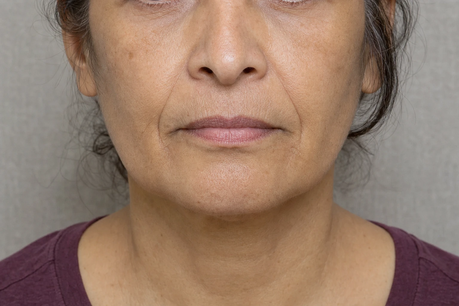 Front view of a woman's mouth and cheeks, showing fine lines above the lip and folds between the nose and the corners of the mouth.